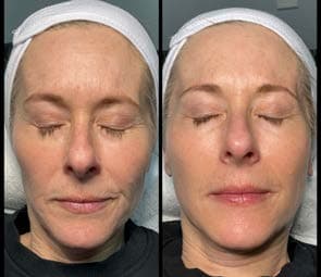 Before and after facial use of an MCC serum, representative