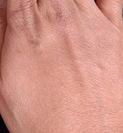 Dorsal hand control with no MCC, representative