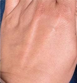 Dorsal hand treated with an MCC formulation, representative